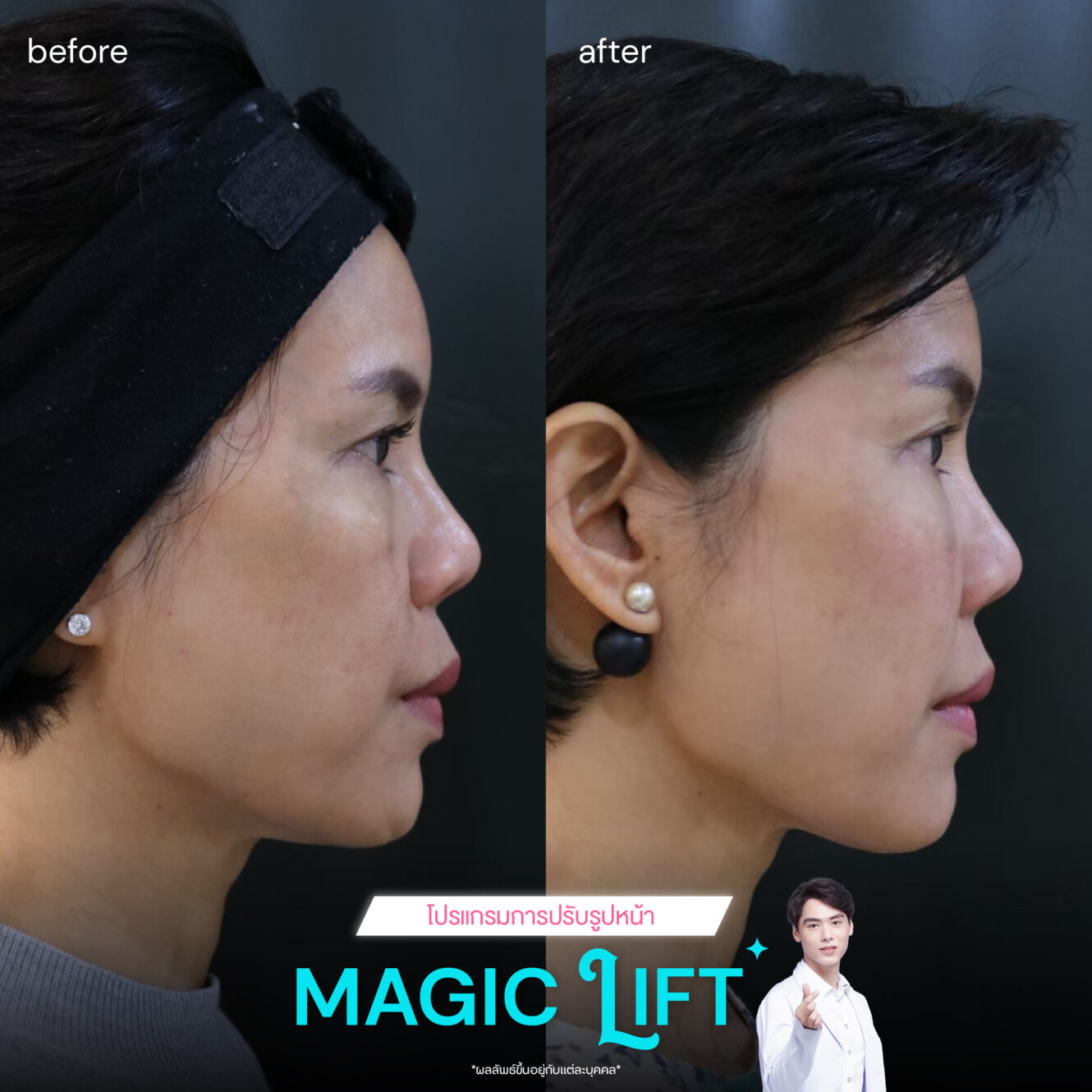 แพทย์ 8 BA Magic lift 03