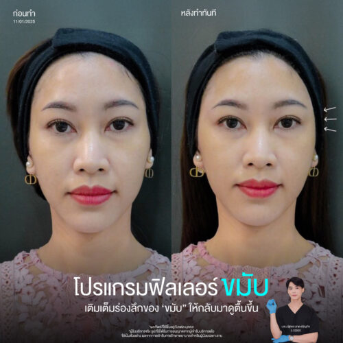 ข้อควรรู้ก่อนฉีดโปรแกรมฟิลเลอร์ขมับ ช่วยเรื่องอะไร อันตรายไหม ฉีดยี่ห้อไหนดี 2 ฟิลเลอร์ขมับ คือ