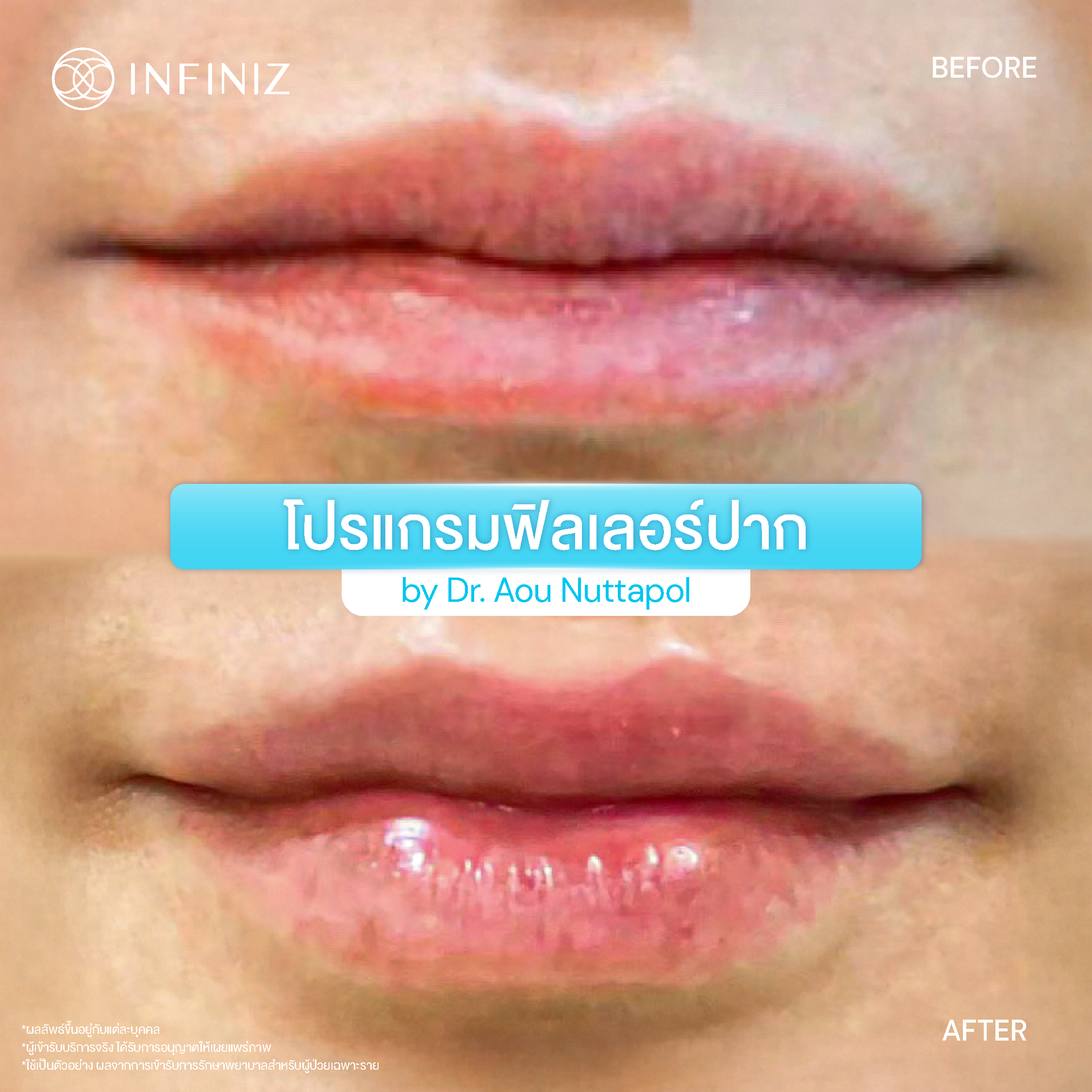 5 ข้อควรรู้ก่อนตัดสินใจ โปรแกรมฉีดฟิลเลอร์ปากเกาหลี 3 BA Lip Aug 25 09