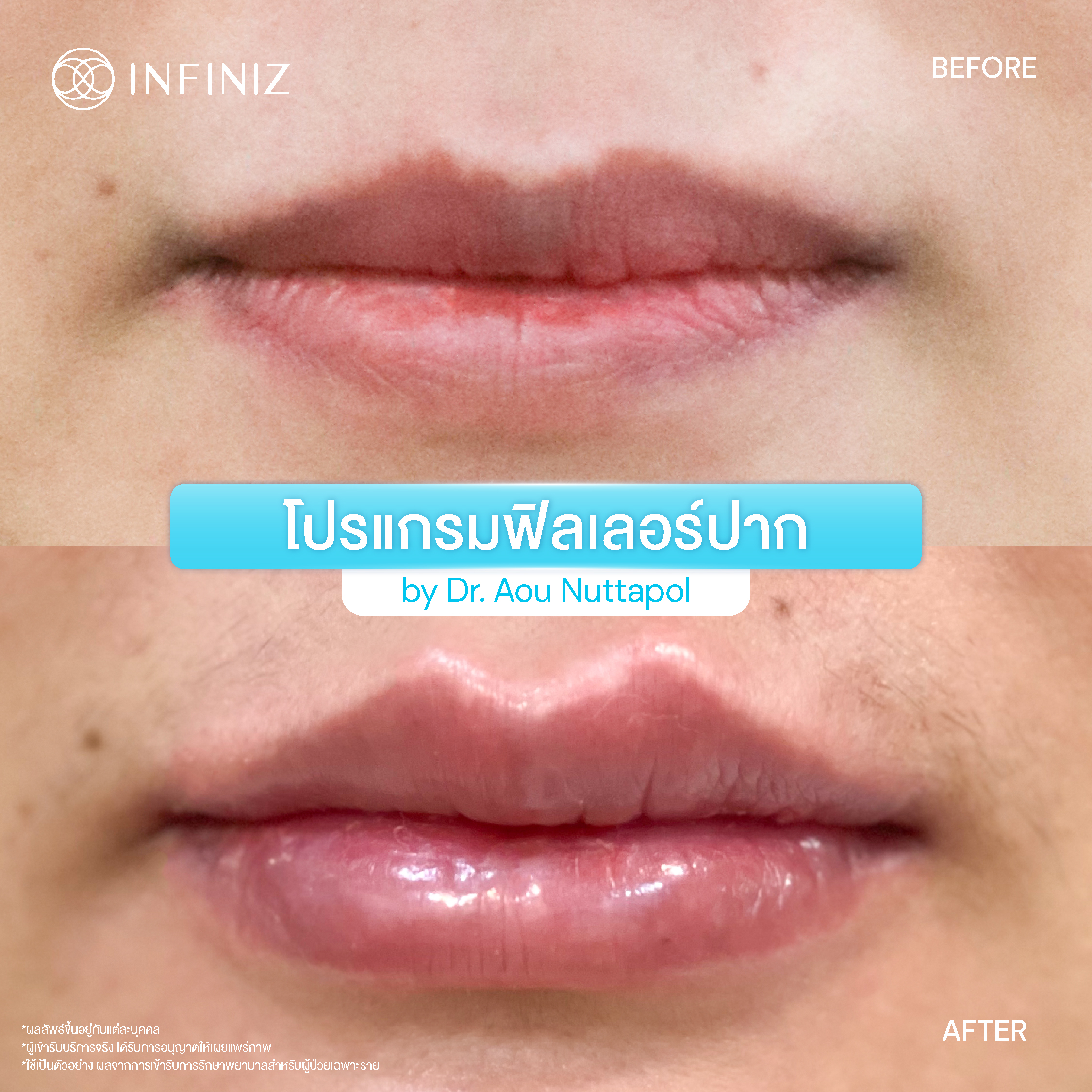 5 ข้อควรรู้ก่อนตัดสินใจ โปรแกรมฉีดฟิลเลอร์ปากเกาหลี 6 BA Lip Aug 25 10