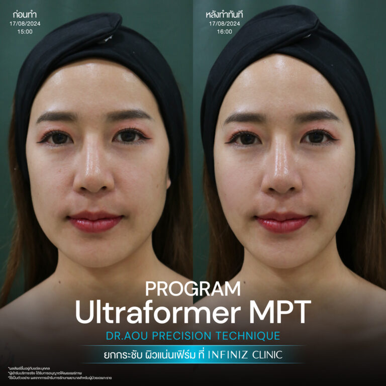 ปรับรูปหน้าให้เรียวสวย ด้วยโปรแกรมUltraformer MPT ที่ Infiniz Clinic 4 BA Oct 25 06