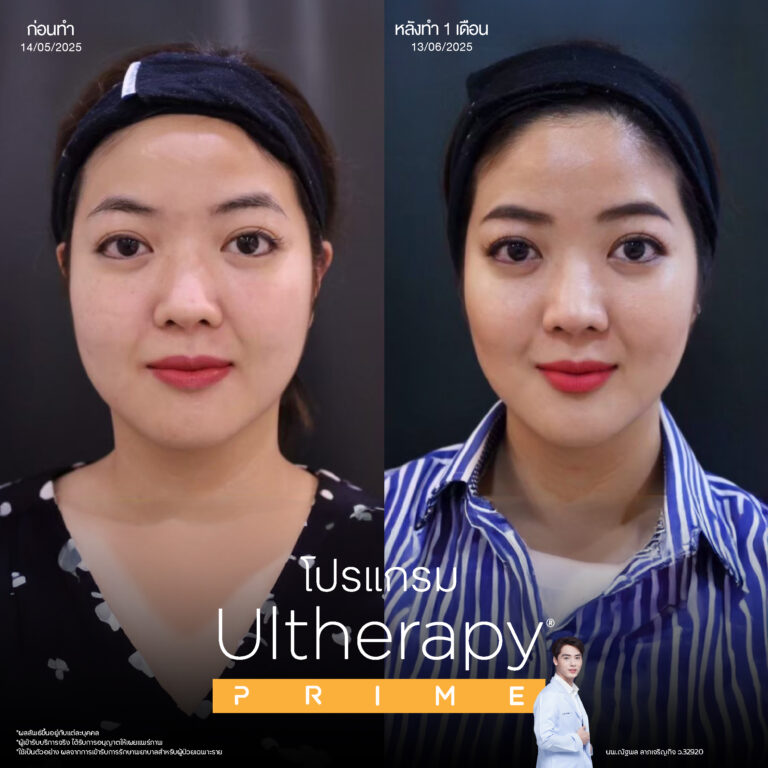 Ulthera โปรแกรมยกกระชับใบหน้าที่ได้รับความนิยมมากที่สุด 3 BA Prime 16