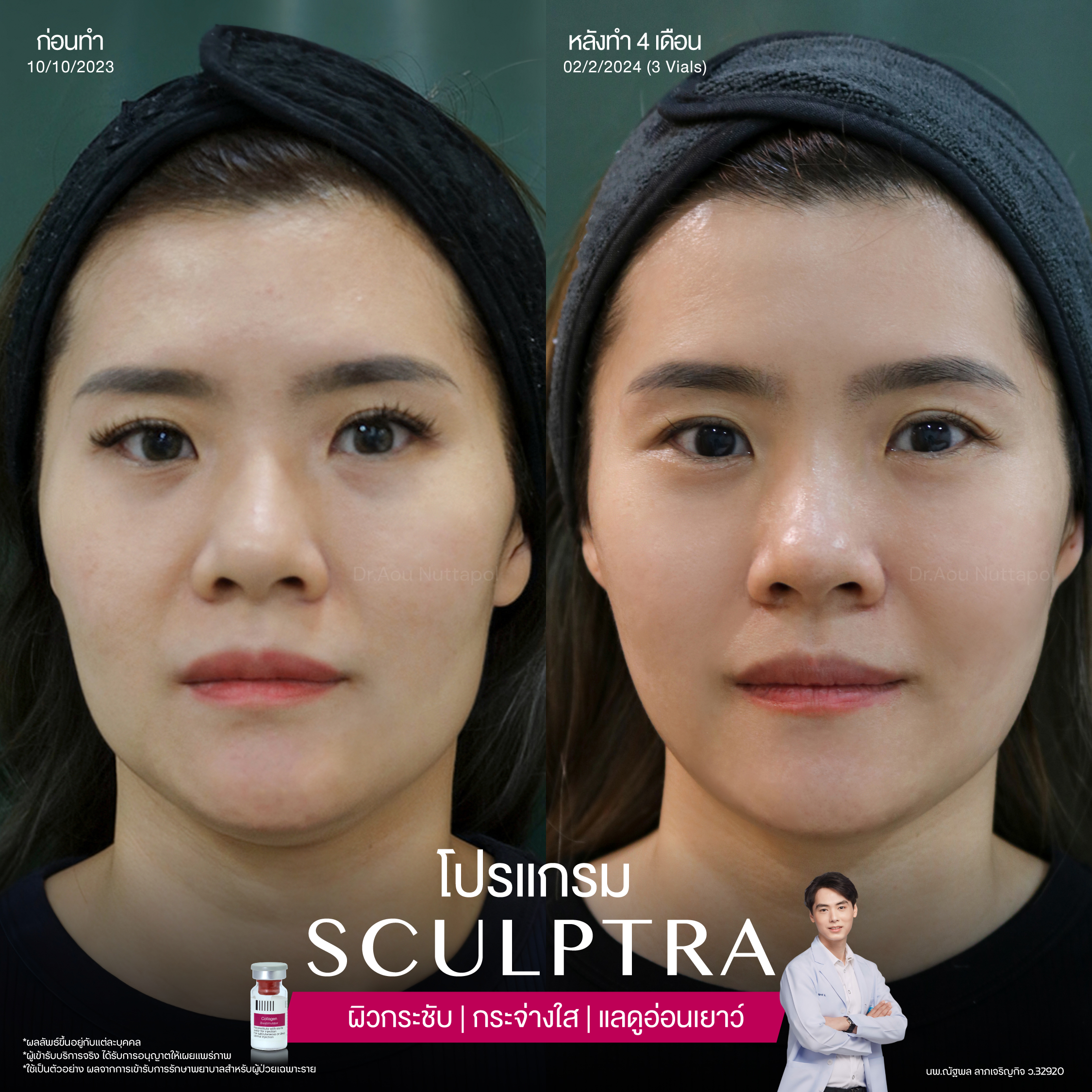 ยกกระชับด้วย โปรแกรมSculptra® Multidimensions 1 Alt