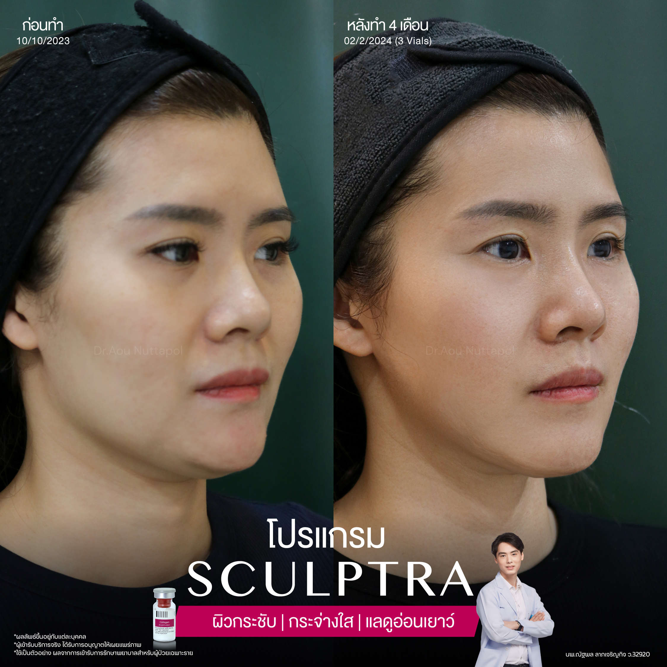 ยกกระชับด้วย โปรแกรมSculptra® Multidimensions 2 Alt