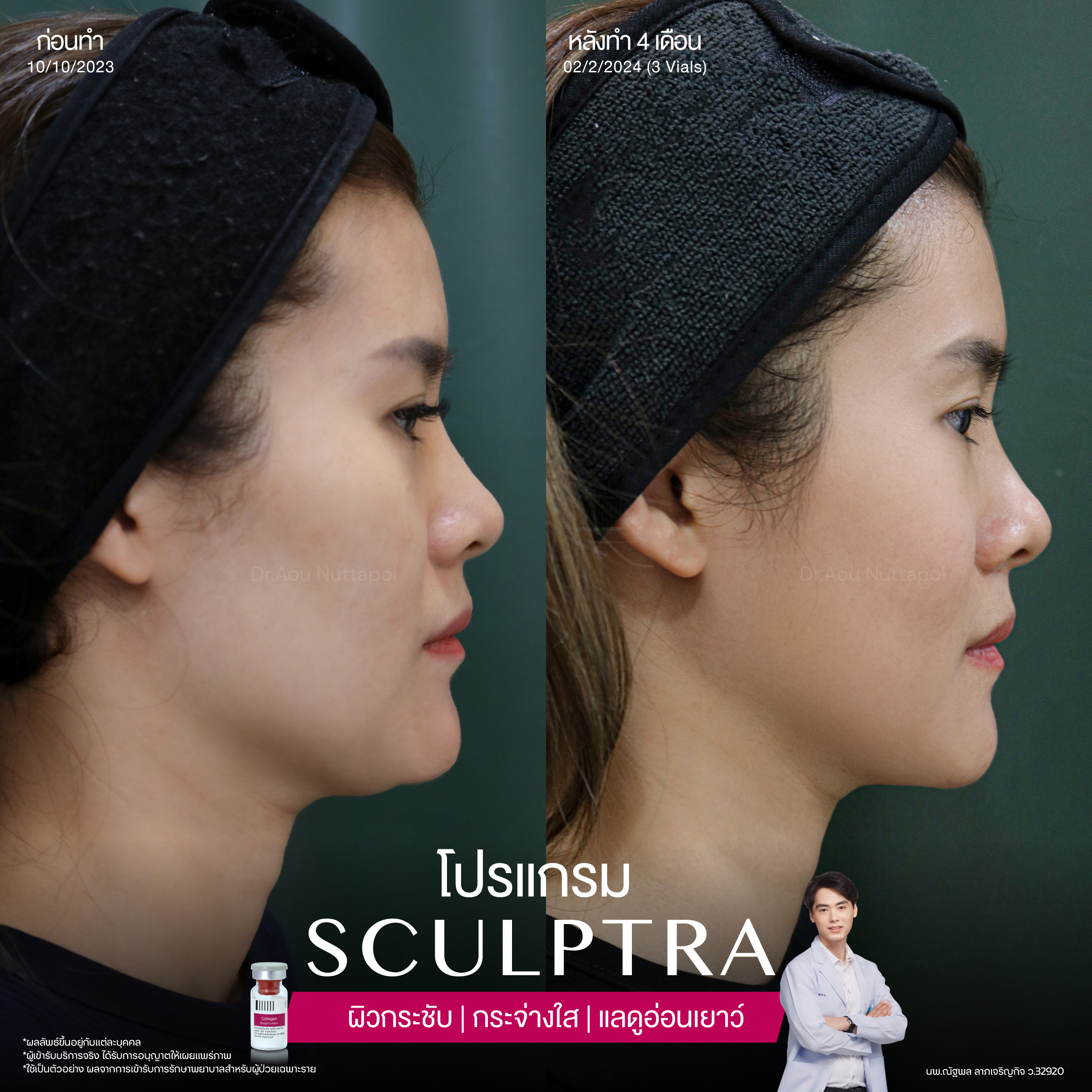 ยกกระชับด้วย โปรแกรมSculptra® Multidimensions 3 Alt