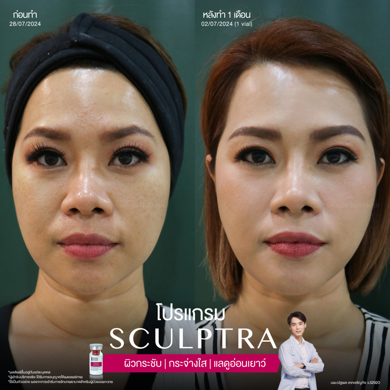 โปรแกรมฟื้นฟูผิวที่เสื่อมสภาพไปตามวัย 4 BA Sculptra 04