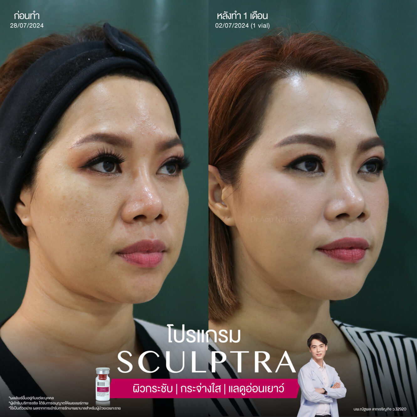 โปรแกรมฟื้นฟูผิวที่เสื่อมสภาพไปตามวัย 5 BA Sculptra 05