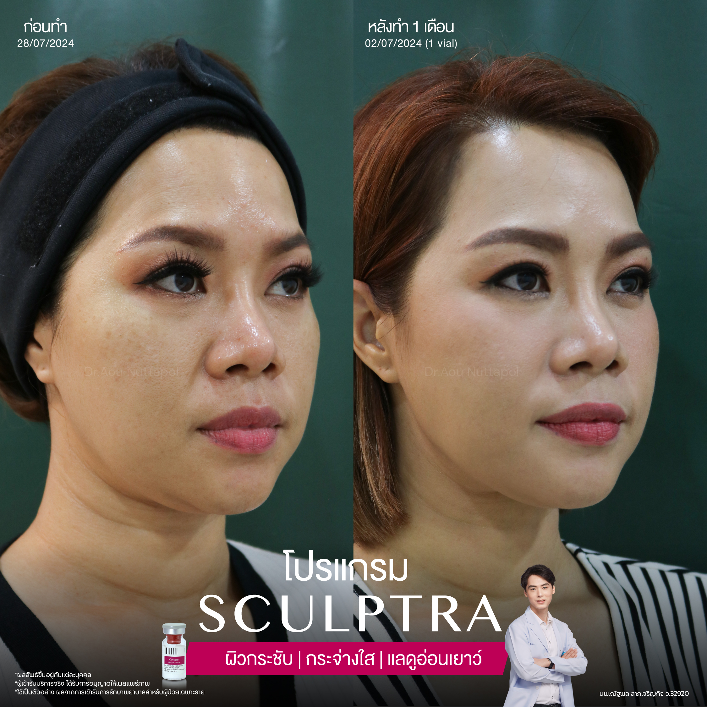 ยกกระชับด้วย โปรแกรมSculptra® Multidimensions 5 Alt