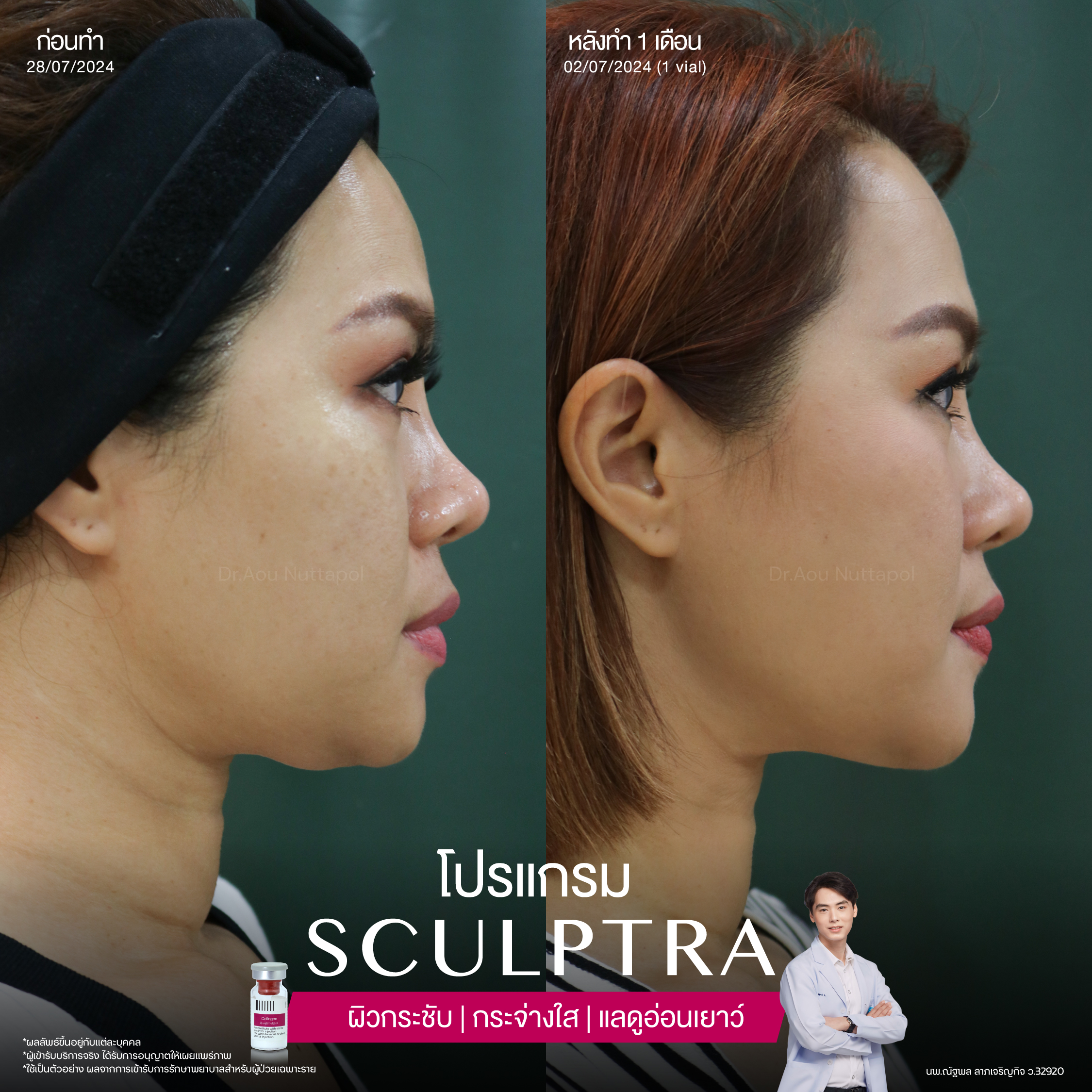 ยกกระชับด้วย โปรแกรมSculptra® Multidimensions 6 Alt