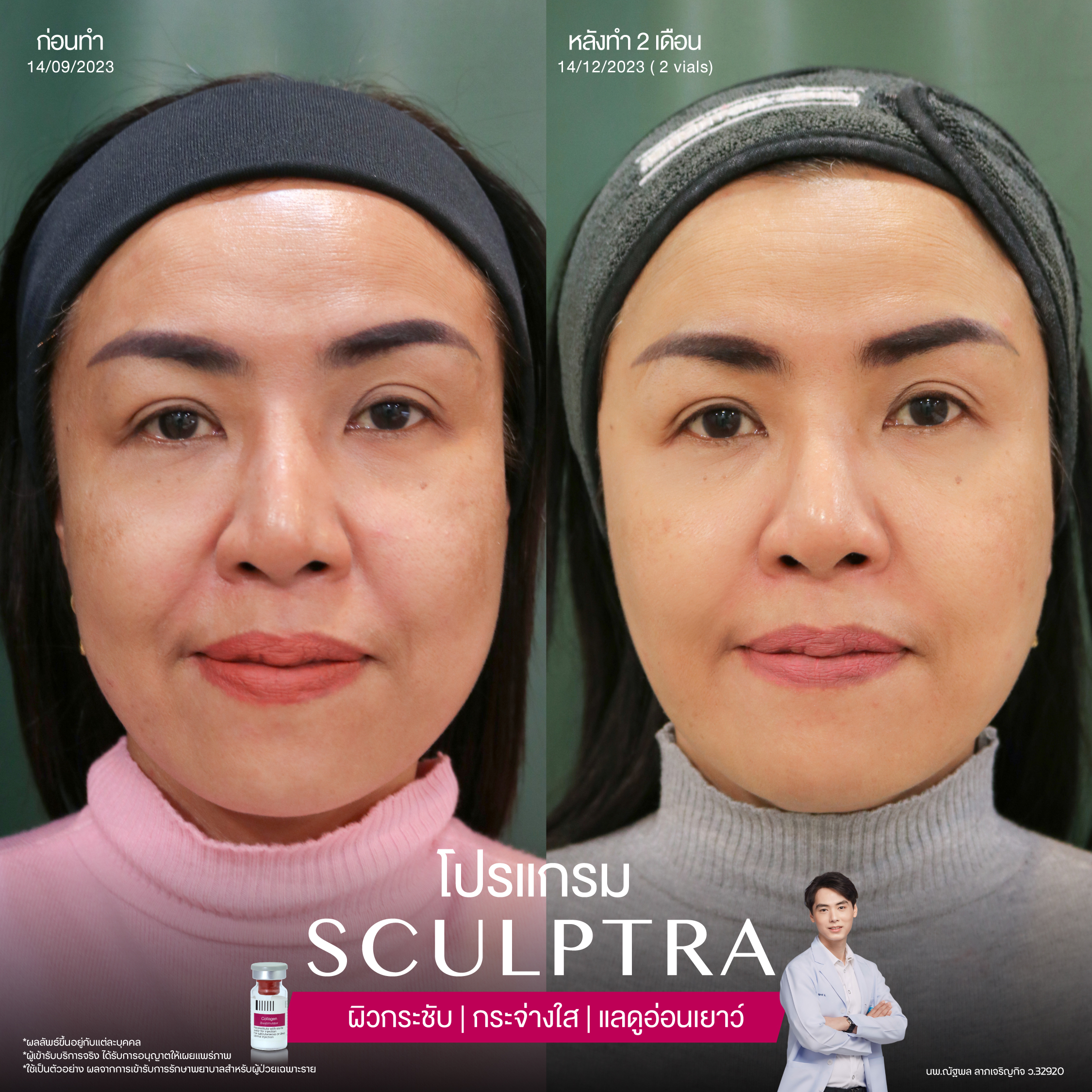 ยกกระชับด้วย โปรแกรมSculptra® Multidimensions 7 Alt