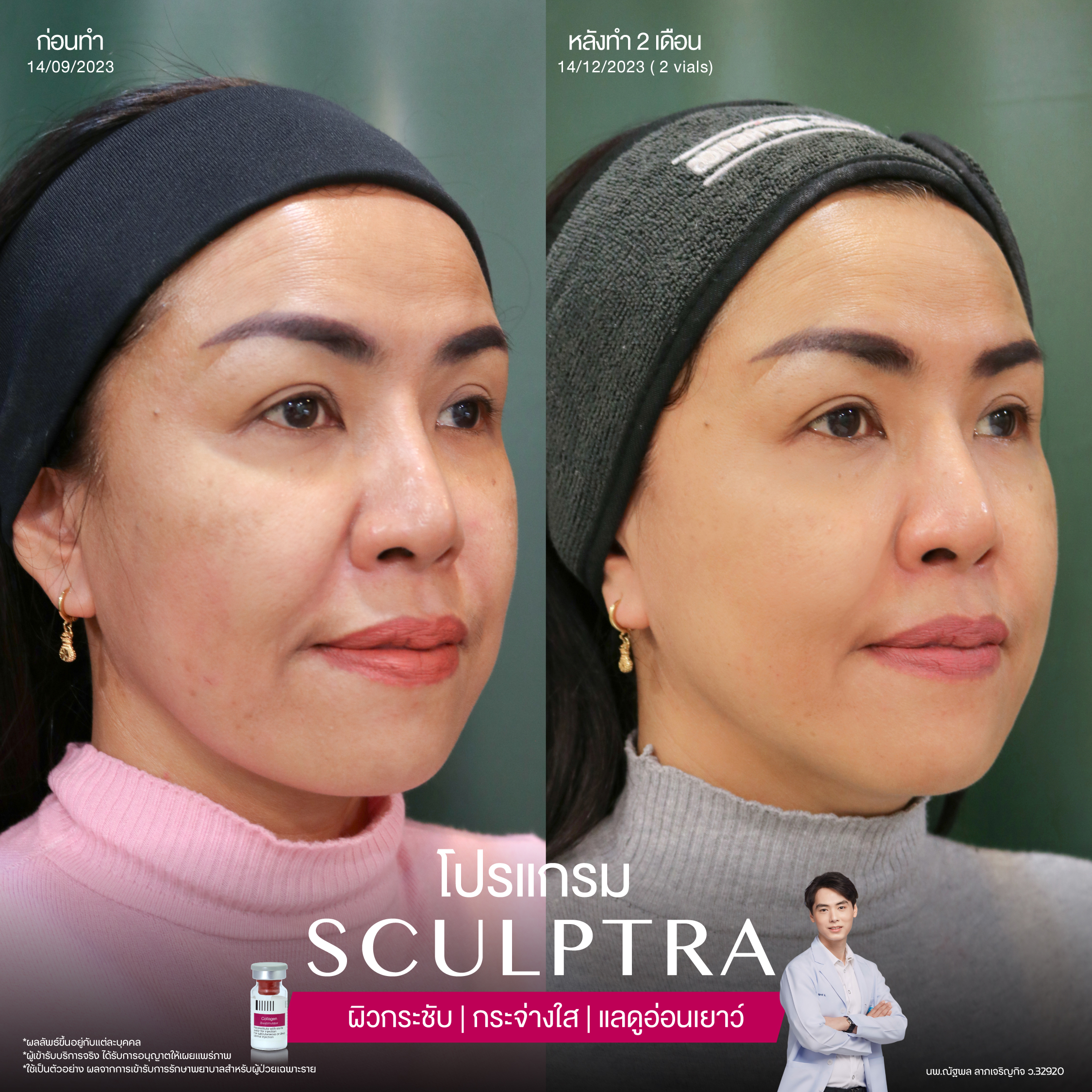 ยกกระชับด้วย โปรแกรมSculptra® Multidimensions 8 Alt
