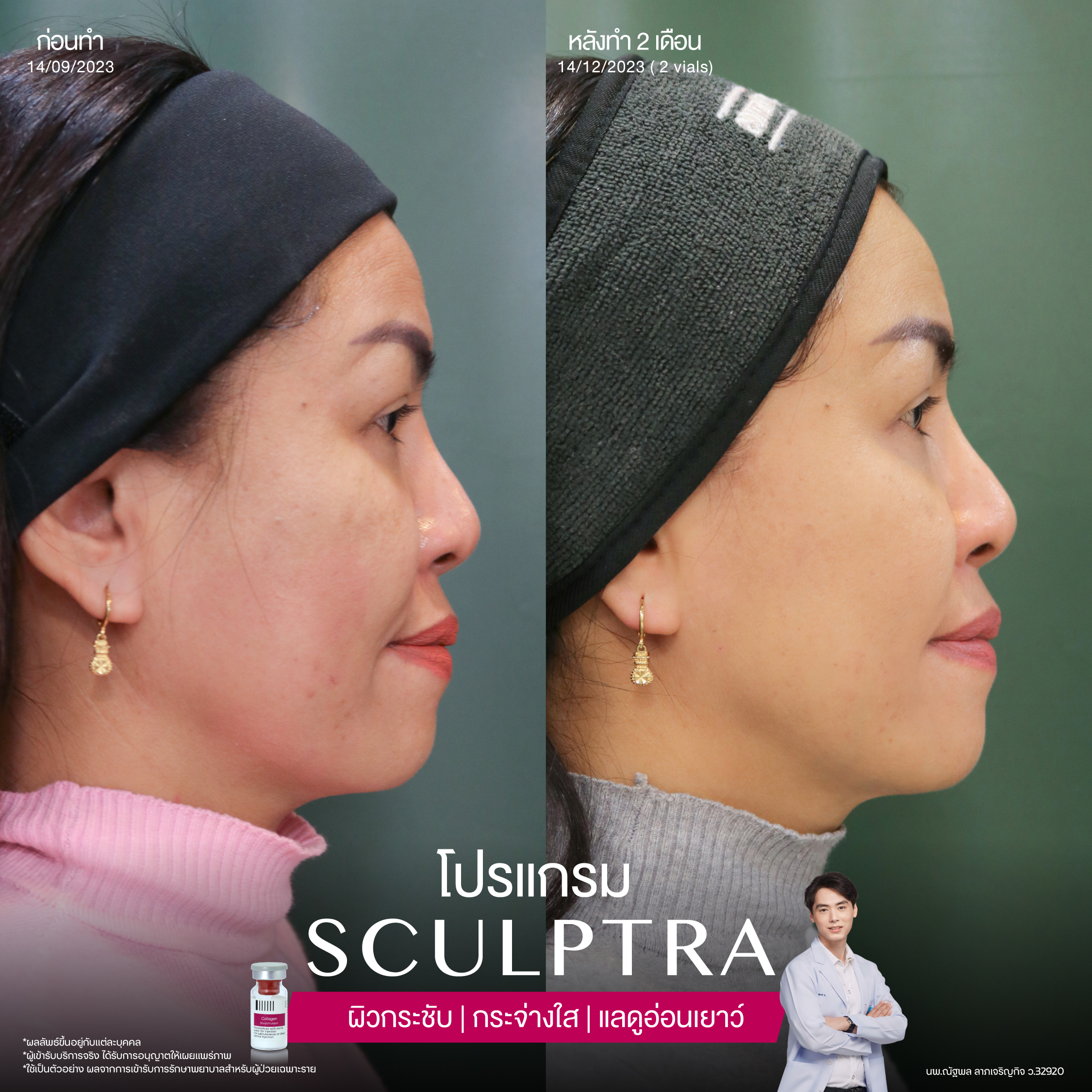 ยกกระชับด้วย โปรแกรมSculptra® Multidimensions 9 Alt