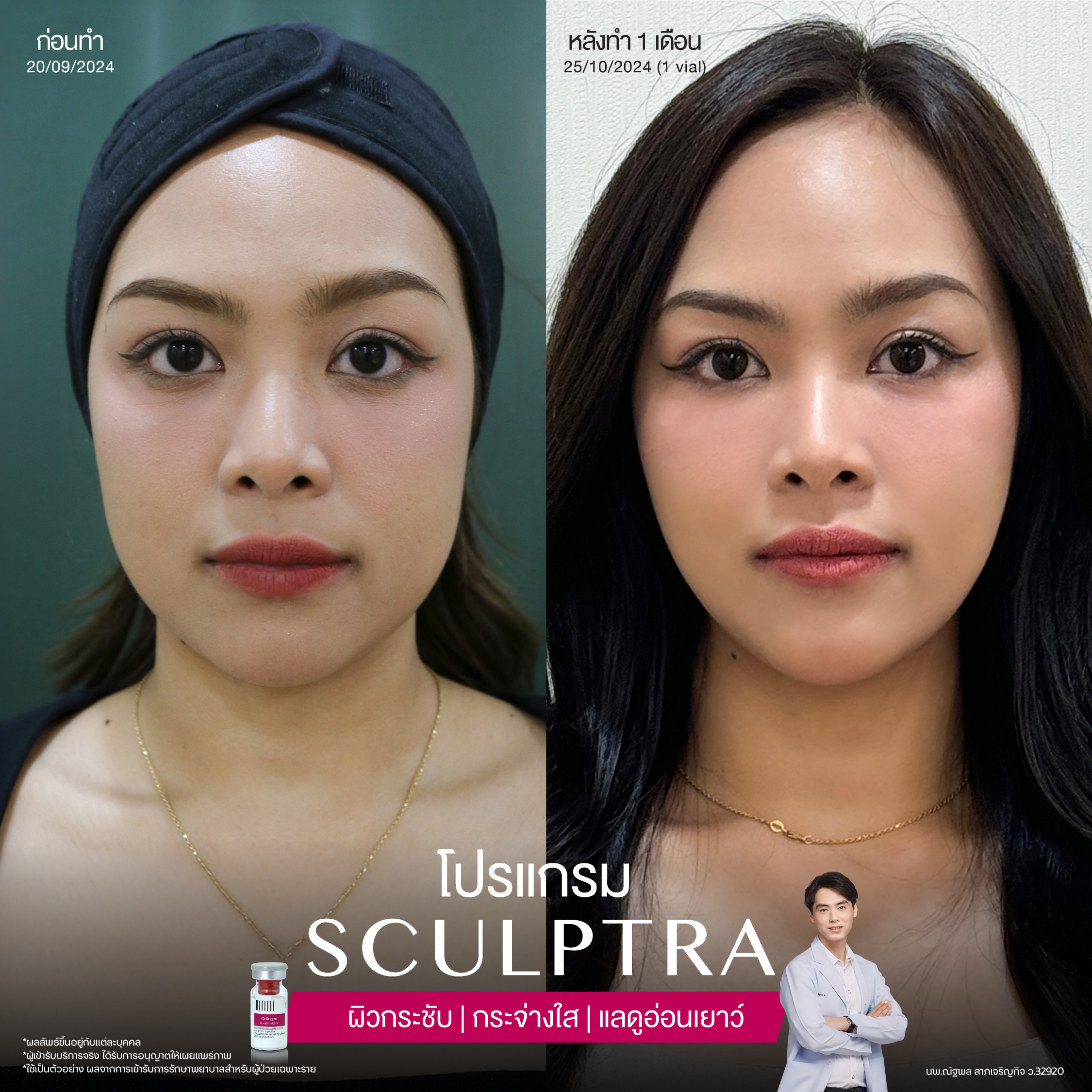 ยกกระชับด้วย โปรแกรมSculptra® Multidimensions 13 Alt