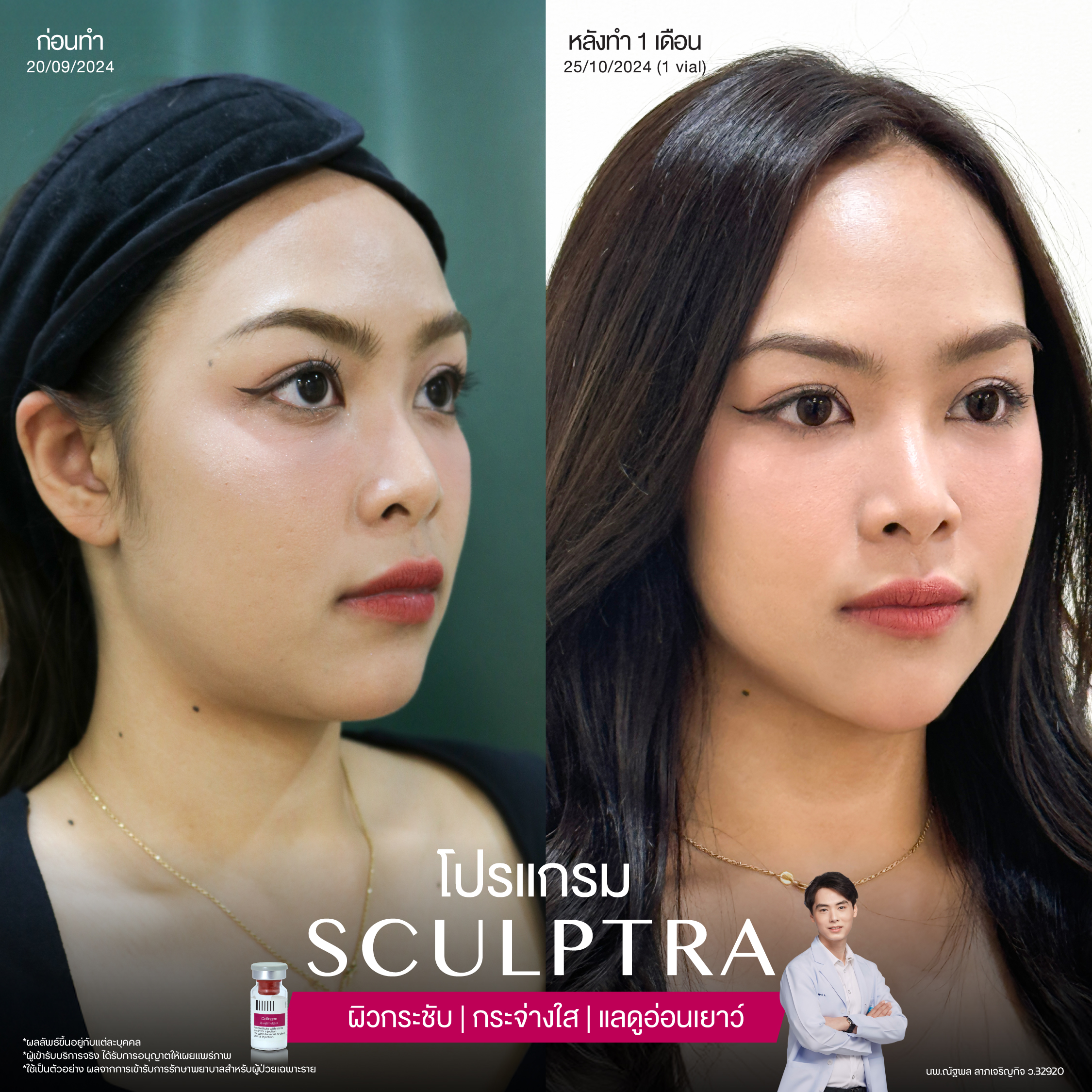 ยกกระชับด้วย โปรแกรมSculptra® Multidimensions 14 Alt