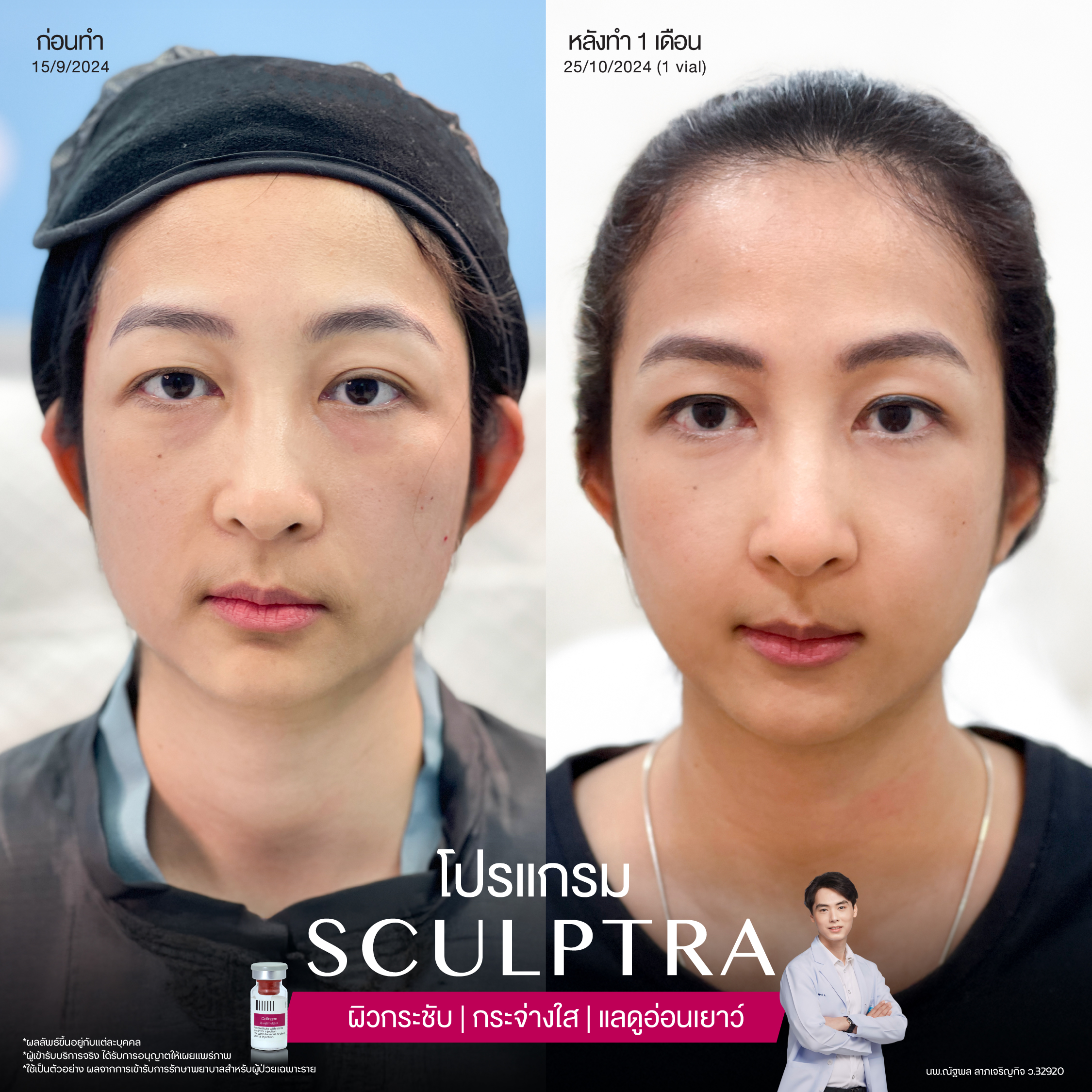 ยกกระชับด้วย โปรแกรมSculptra® Multidimensions 15 Alt