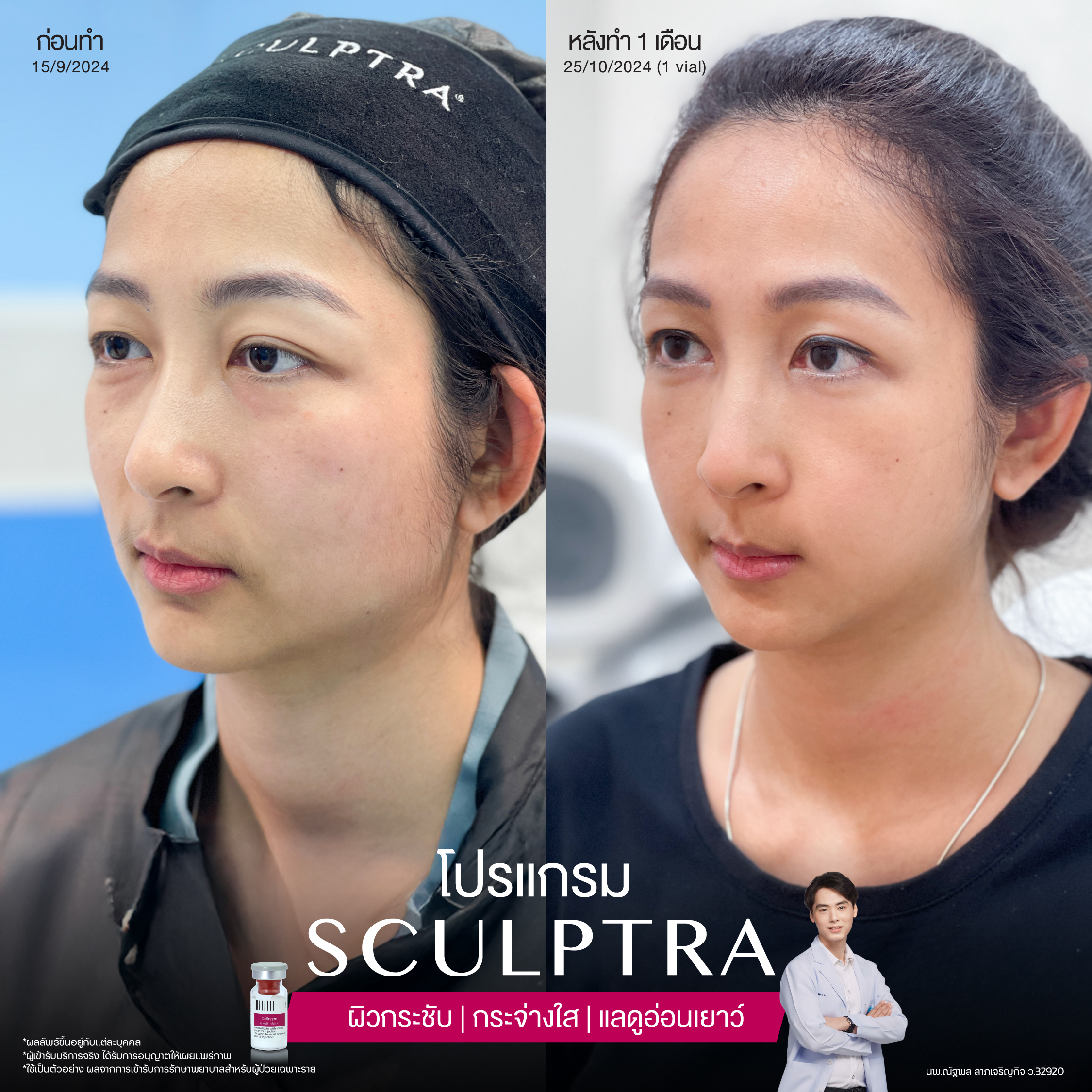 ยกกระชับด้วย โปรแกรมSculptra® Multidimensions 16 Alt