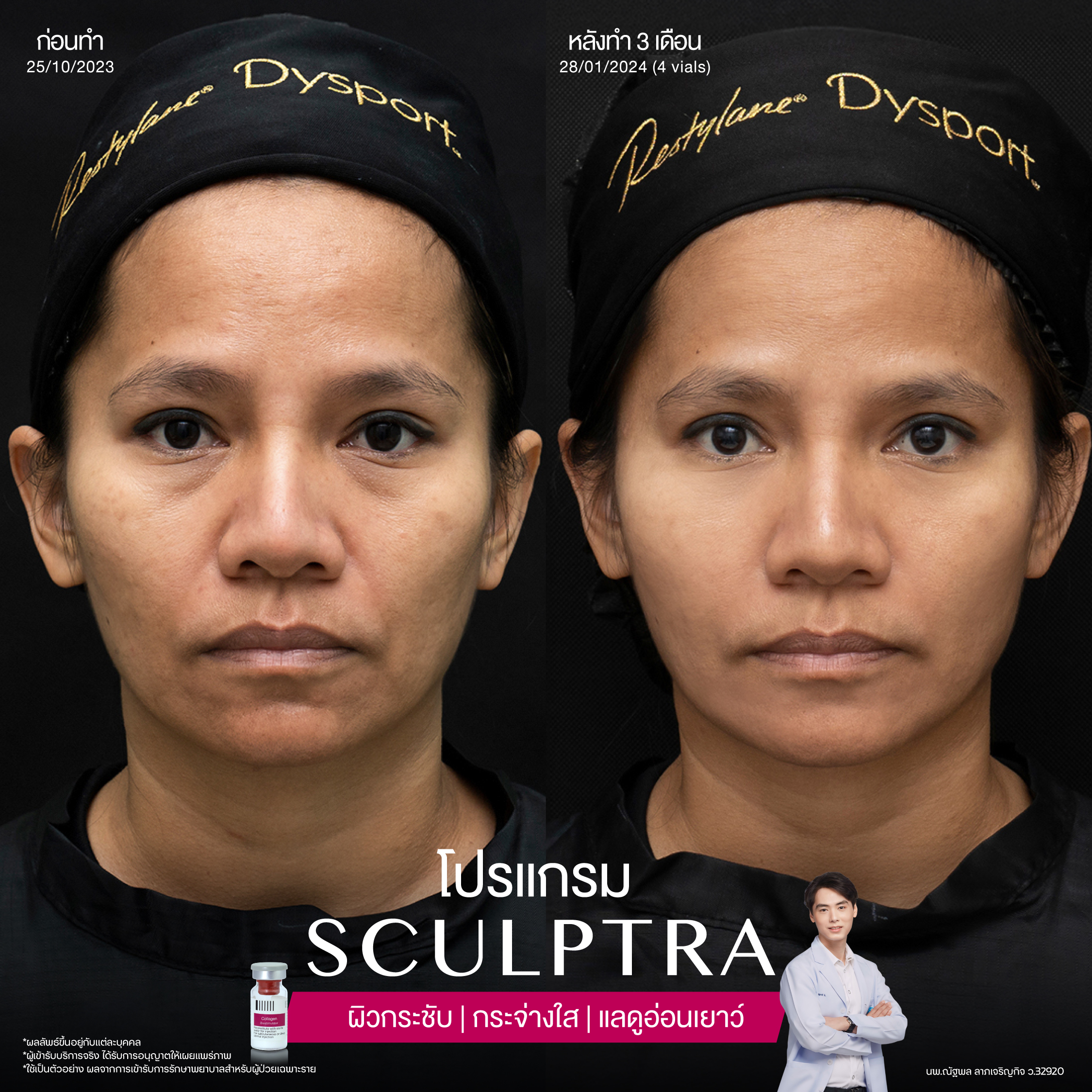 ยกกระชับด้วย โปรแกรมSculptra® Multidimensions 10 Alt