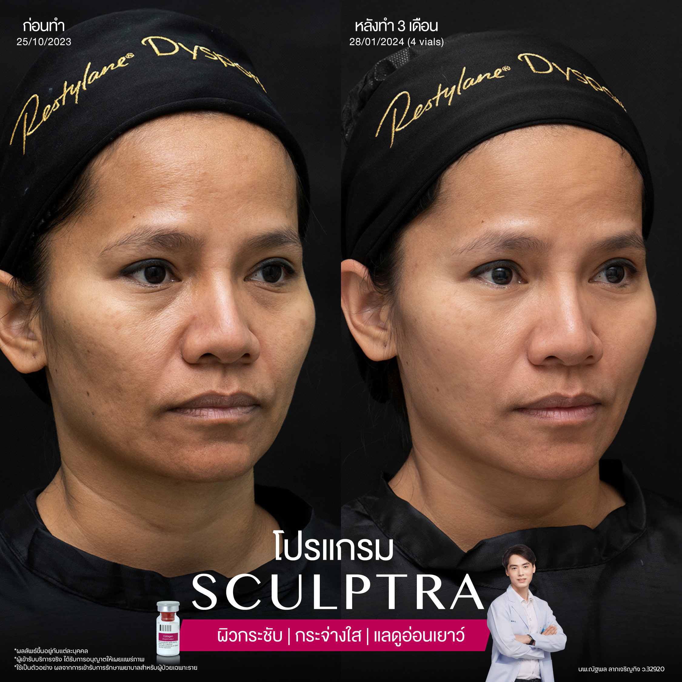 ยกกระชับด้วย โปรแกรมSculptra® Multidimensions 11 Alt