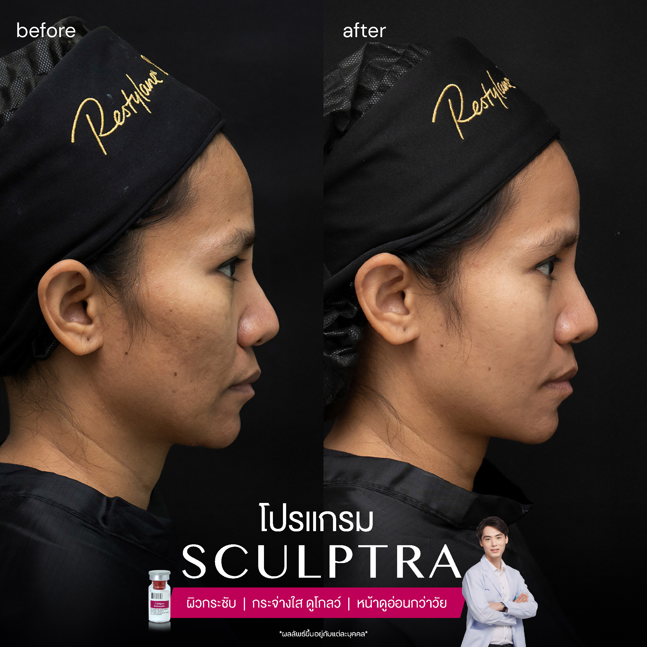 ยกกระชับด้วย โปรแกรมSculptra® Multidimensions 12 Alt