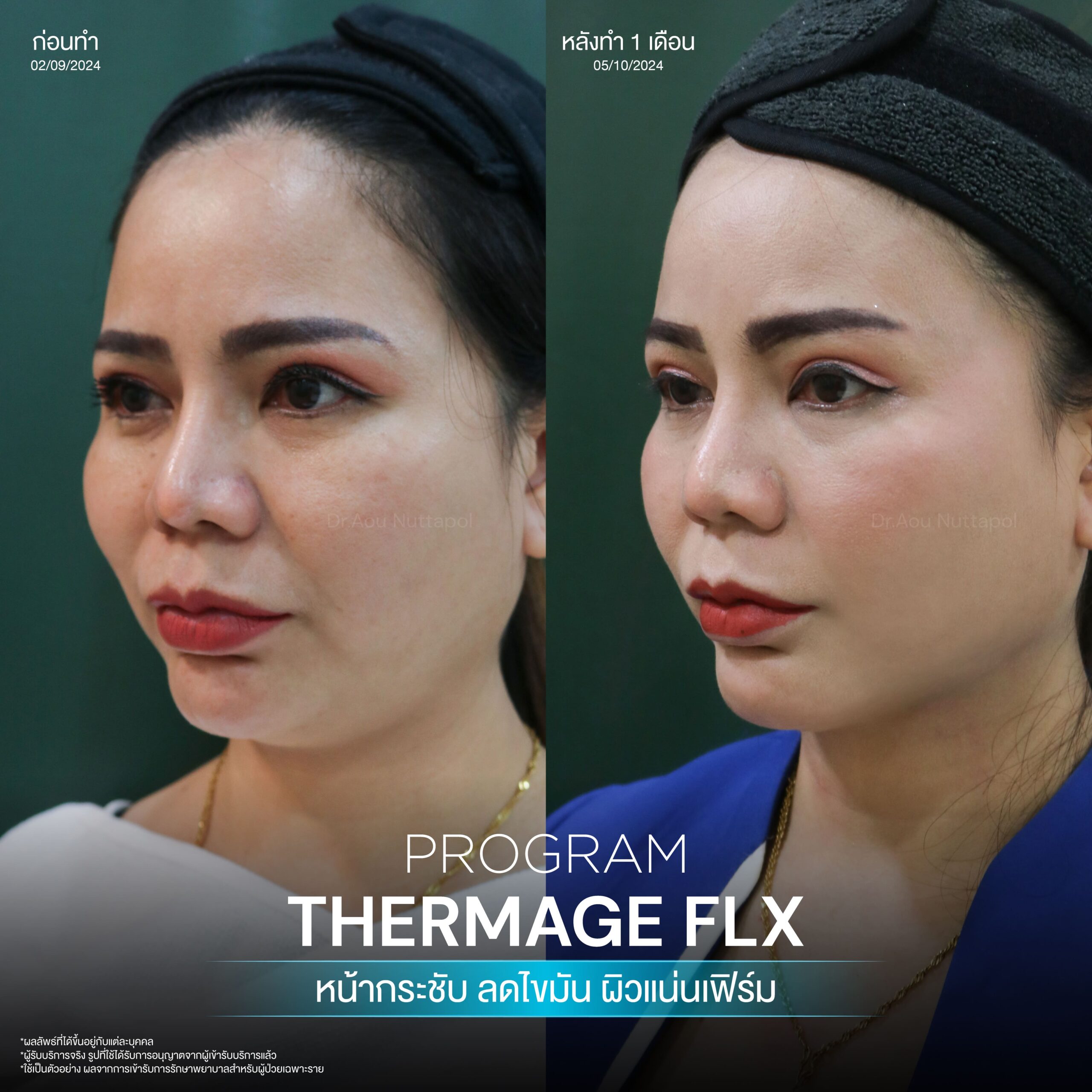 โปรแกรม Thermage FLX คืออะไรและมีหลักการทำงานอย่างไร เพื่อยกกระชับผิวหน้า 10 BA Thermage 02