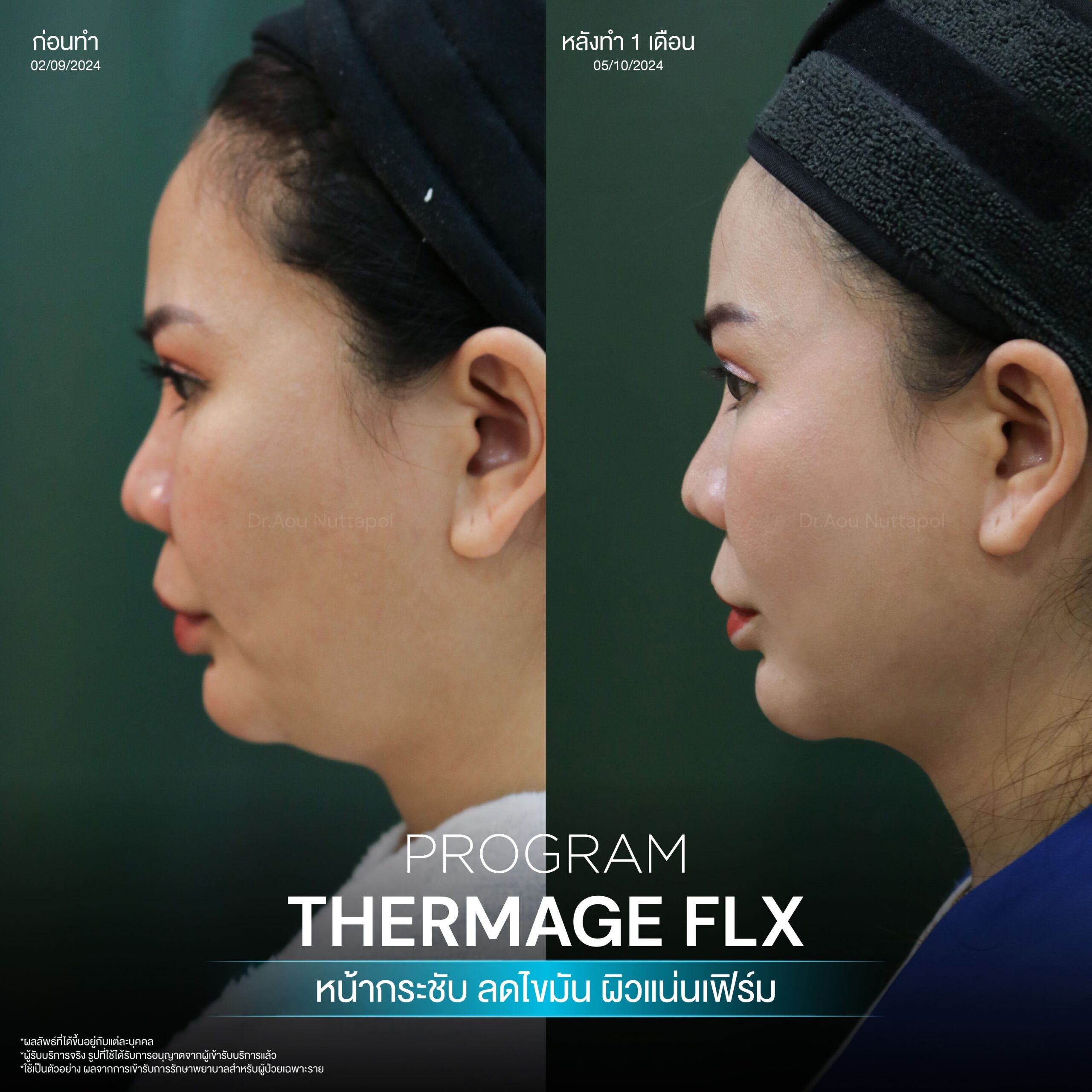 โปรแกรม Thermage FLX คืออะไรและมีหลักการทำงานอย่างไร เพื่อยกกระชับผิวหน้า 12 BA Thermage 03