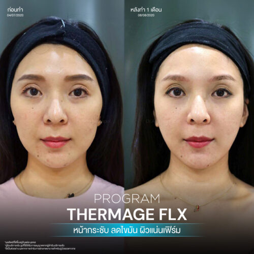 โปรแกรม Thermage FLX คืออะไรและมีหลักการทำงานอย่างไร เพื่อยกกระชับผิวหน้า 9 BA Thermage 05