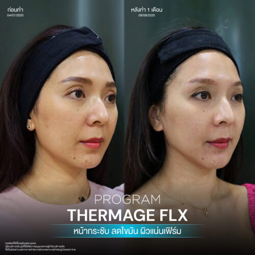 โปรแกรม Thermage FLX คืออะไรและมีหลักการทำงานอย่างไร เพื่อยกกระชับผิวหน้า 11 BA Thermage 06