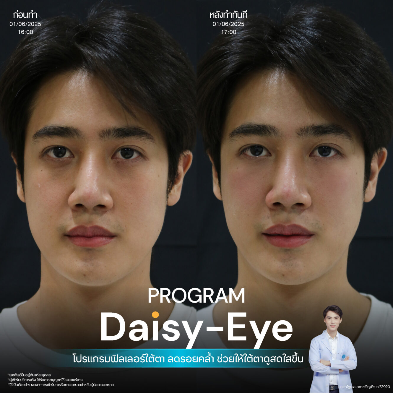โปรแกรม Restylane Vital Light ลดริ้วรอยและร่องลึกใต้ตา 13 Filler ใต้ตา 07