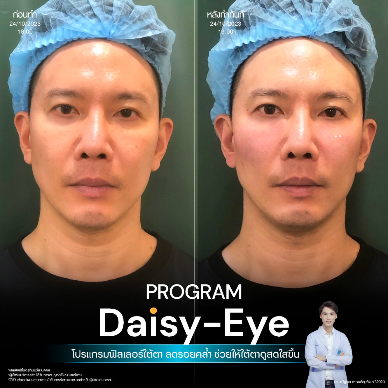 Anatomy บริเวณใต้ตา (Tear Trough Anatomy) 16 Filler ใต้ตา 14