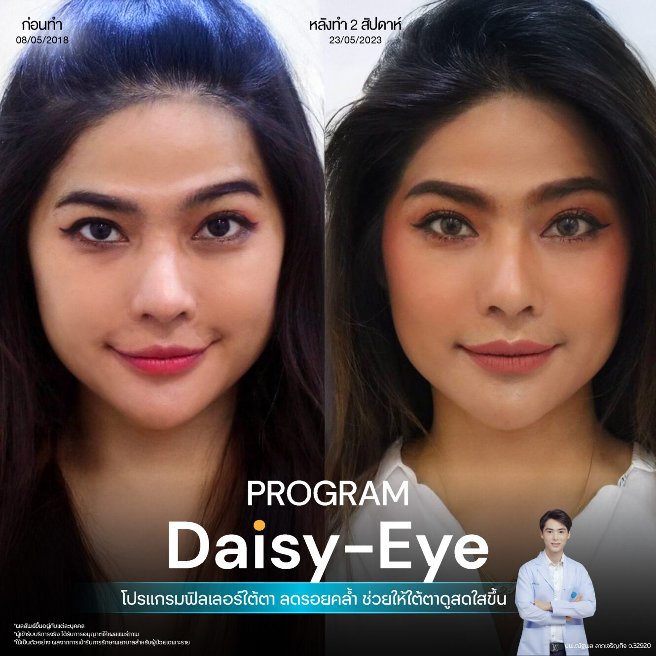 Anatomy บริเวณใต้ตา (Tear Trough Anatomy) 14 Filler ใต้ตา 15