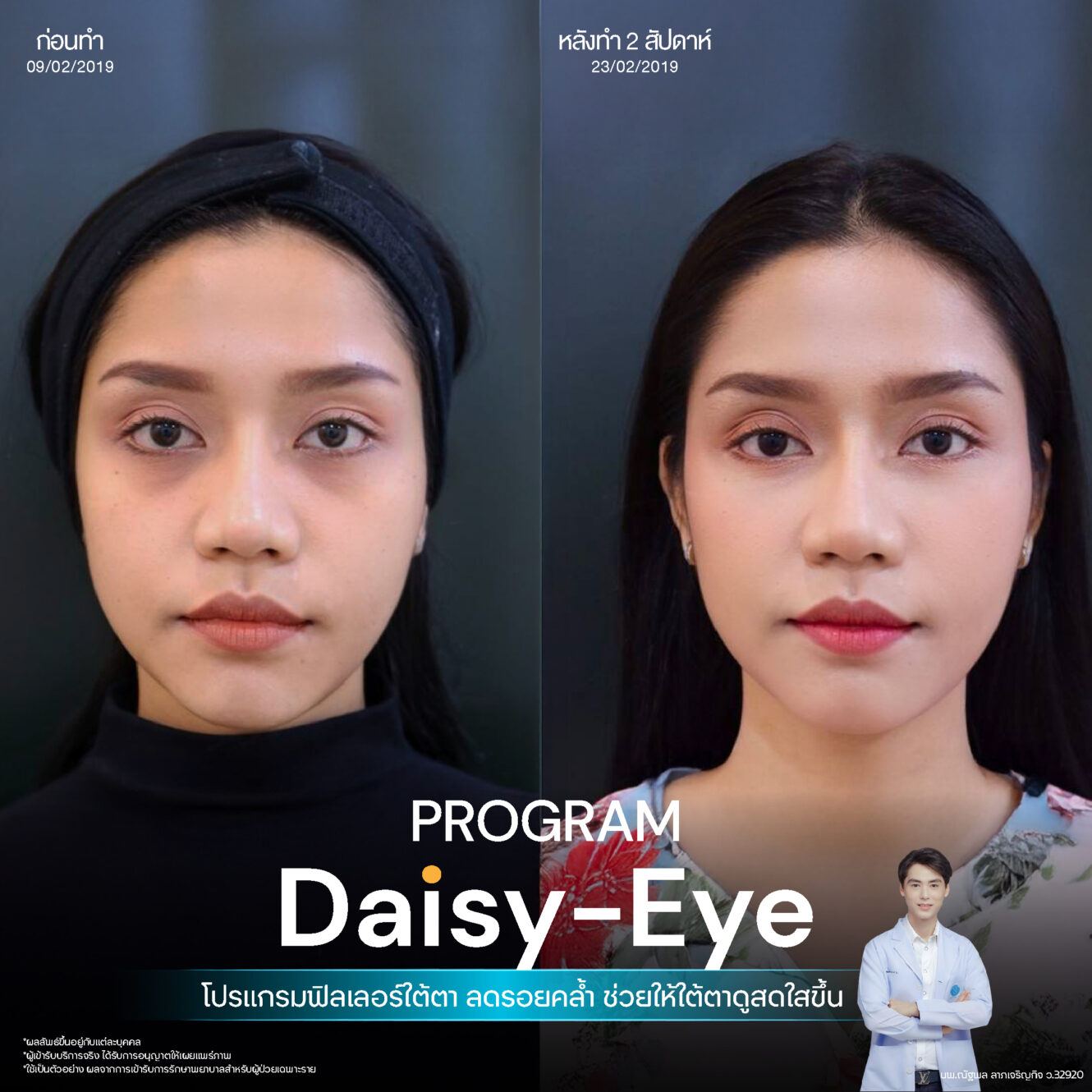 Anatomy บริเวณใต้ตา (Tear Trough Anatomy) 15 Filler ใต้ตา 16