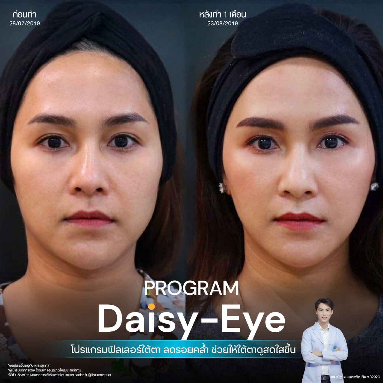 Anatomy บริเวณใต้ตา (Tear Trough Anatomy) 13 Filler ใต้ตา 17