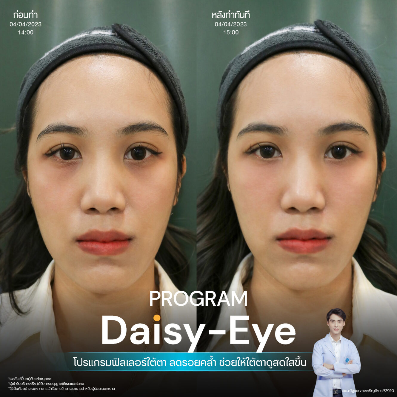 Anatomy บริเวณใต้ตา (Tear Trough Anatomy) 10 Filler ใต้ตา 18