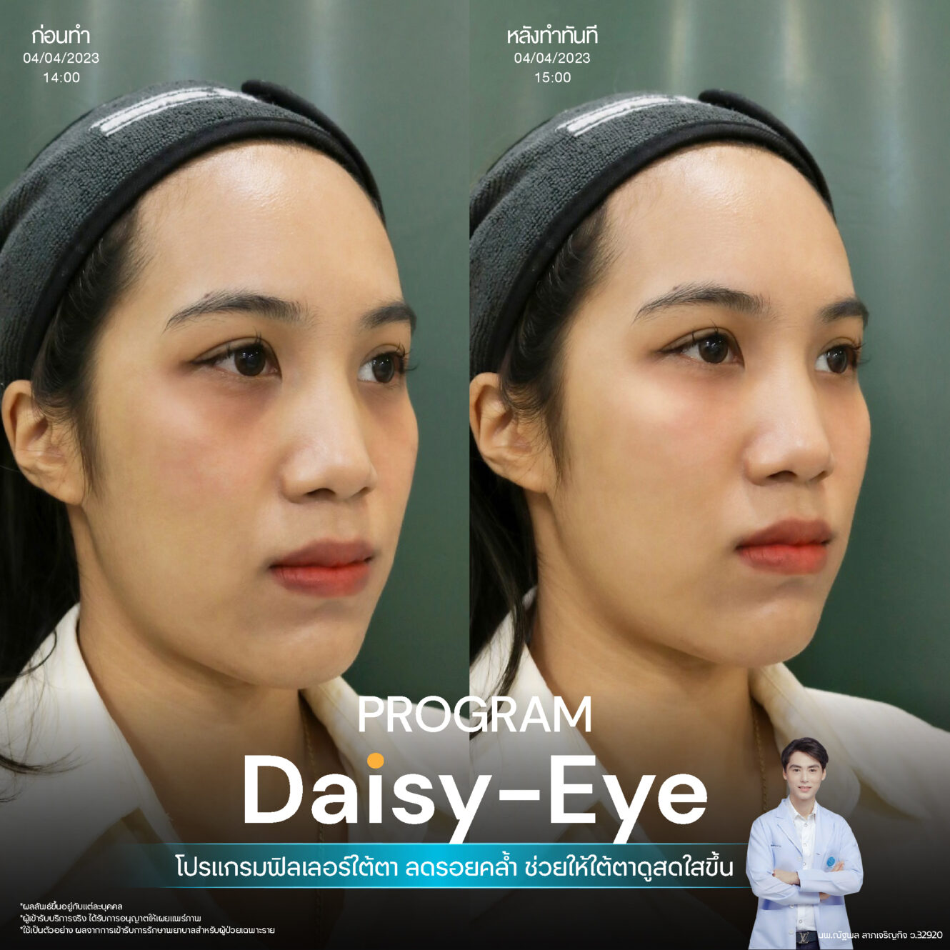 Anatomy บริเวณใต้ตา (Tear Trough Anatomy) 11 Filler ใต้ตา 19