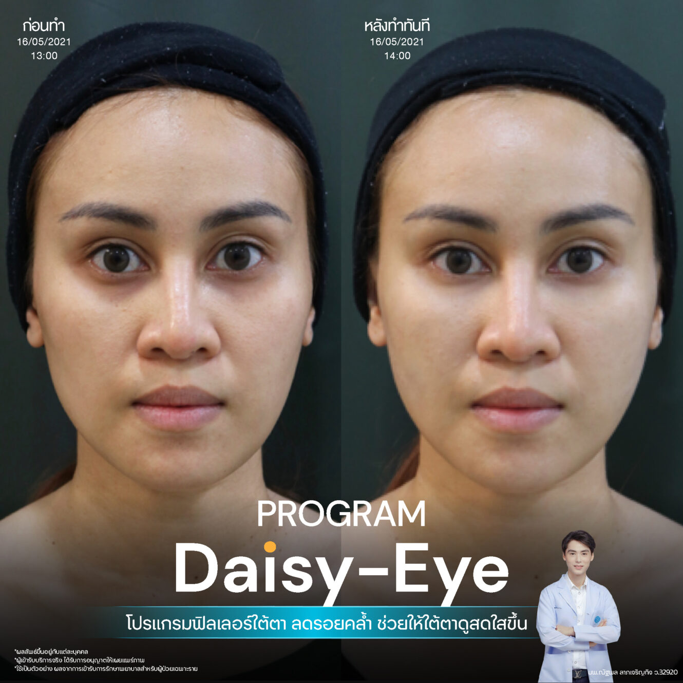 Anatomy บริเวณใต้ตา (Tear Trough Anatomy) 12 Filler ใต้ตา 21