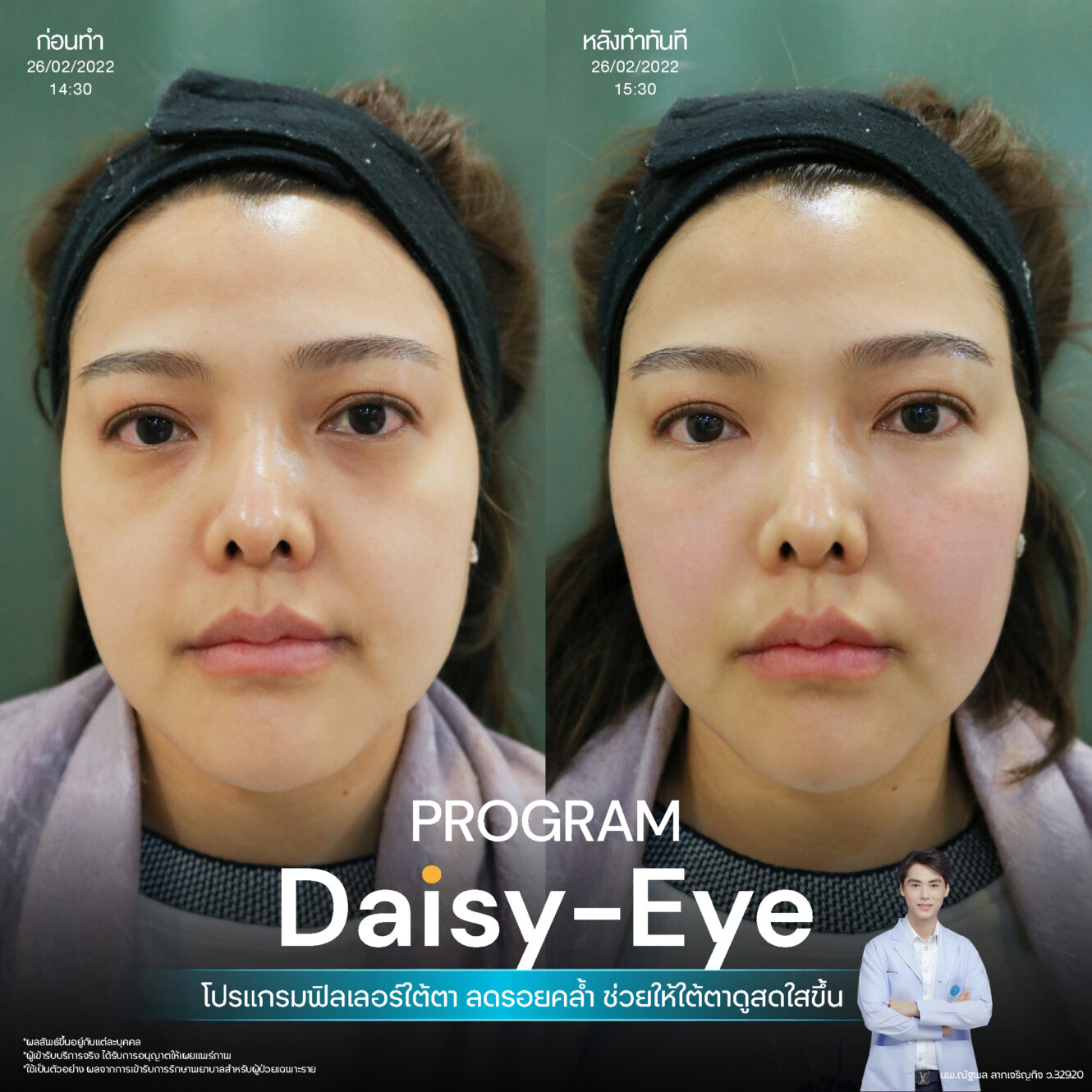 Anatomy บริเวณใต้ตา (Tear Trough Anatomy) 4 Filler ใต้ตา 22