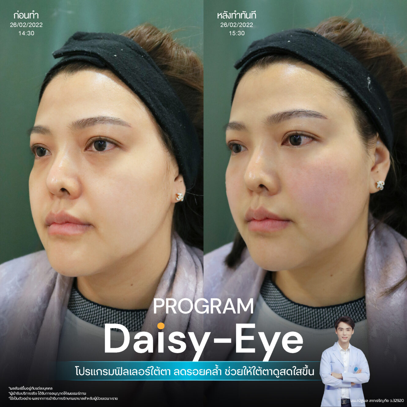 Anatomy บริเวณใต้ตา (Tear Trough Anatomy) 5 Filler ใต้ตา 23