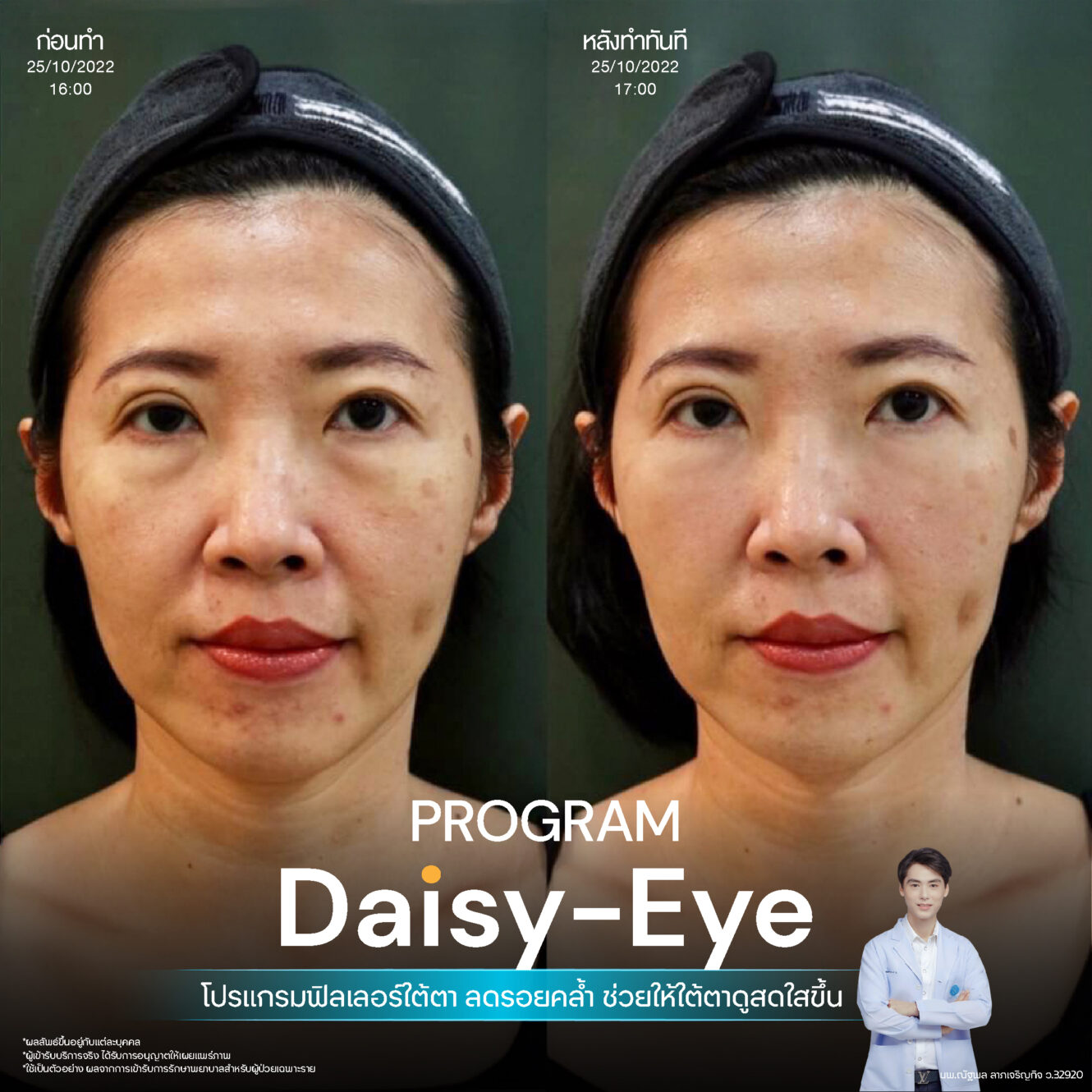 Anatomy บริเวณใต้ตา (Tear Trough Anatomy) 7 Filler ใต้ตา 24