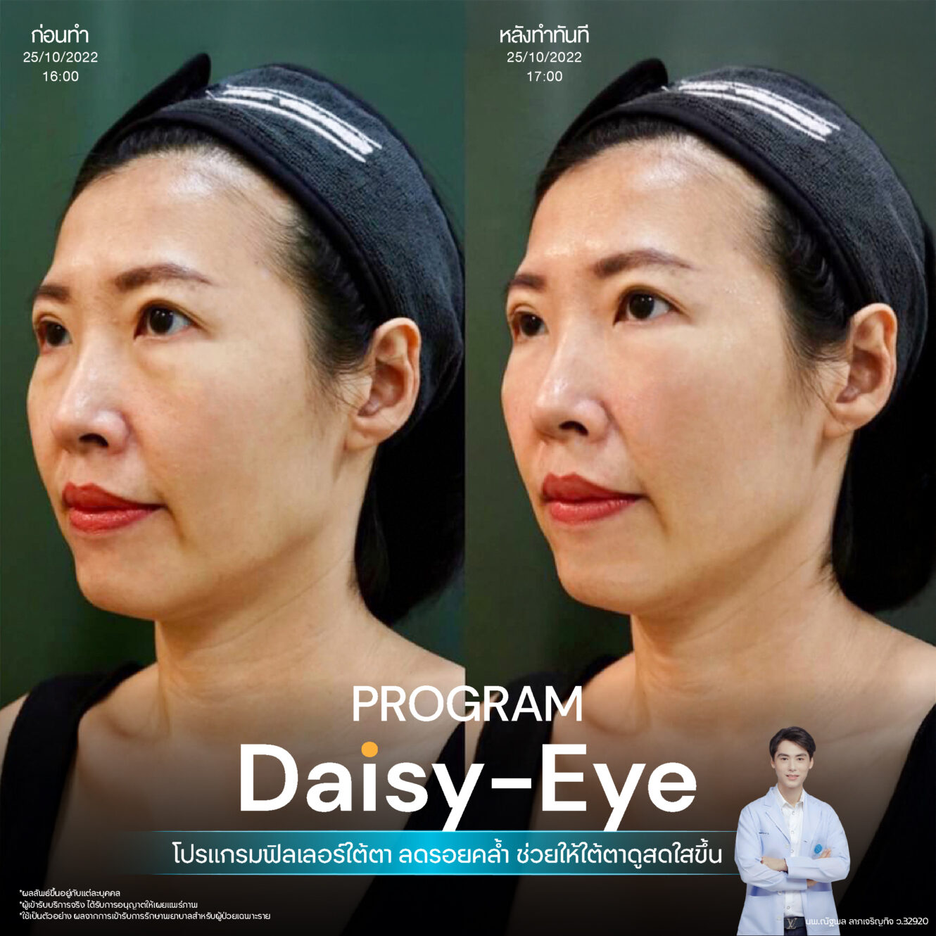 Anatomy บริเวณใต้ตา (Tear Trough Anatomy) 8 Filler ใต้ตา 25