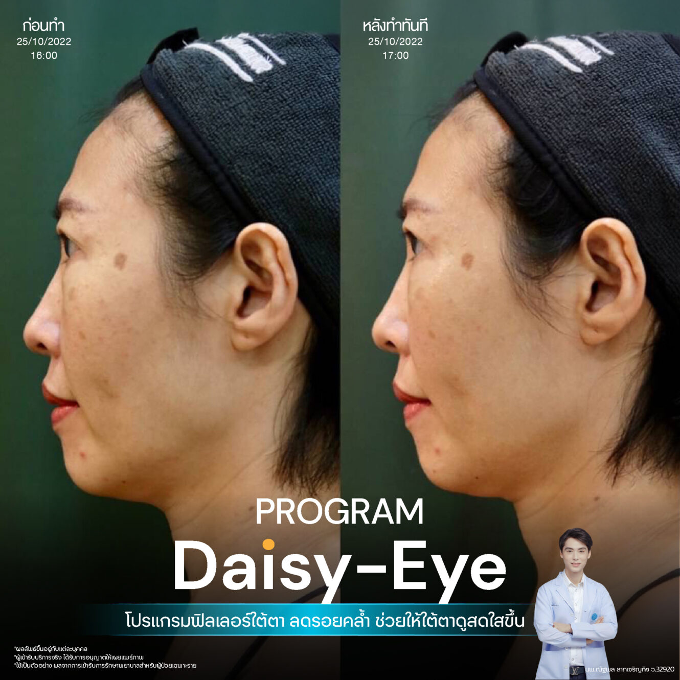 Anatomy บริเวณใต้ตา (Tear Trough Anatomy) 9 Filler ใต้ตา 26