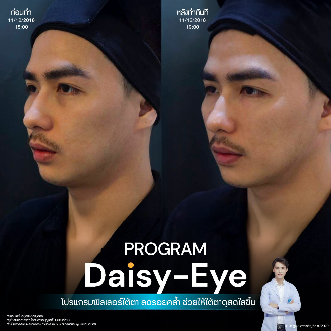 Anatomy บริเวณใต้ตา (Tear Trough Anatomy) 17 Filler ใต้ตา 27
