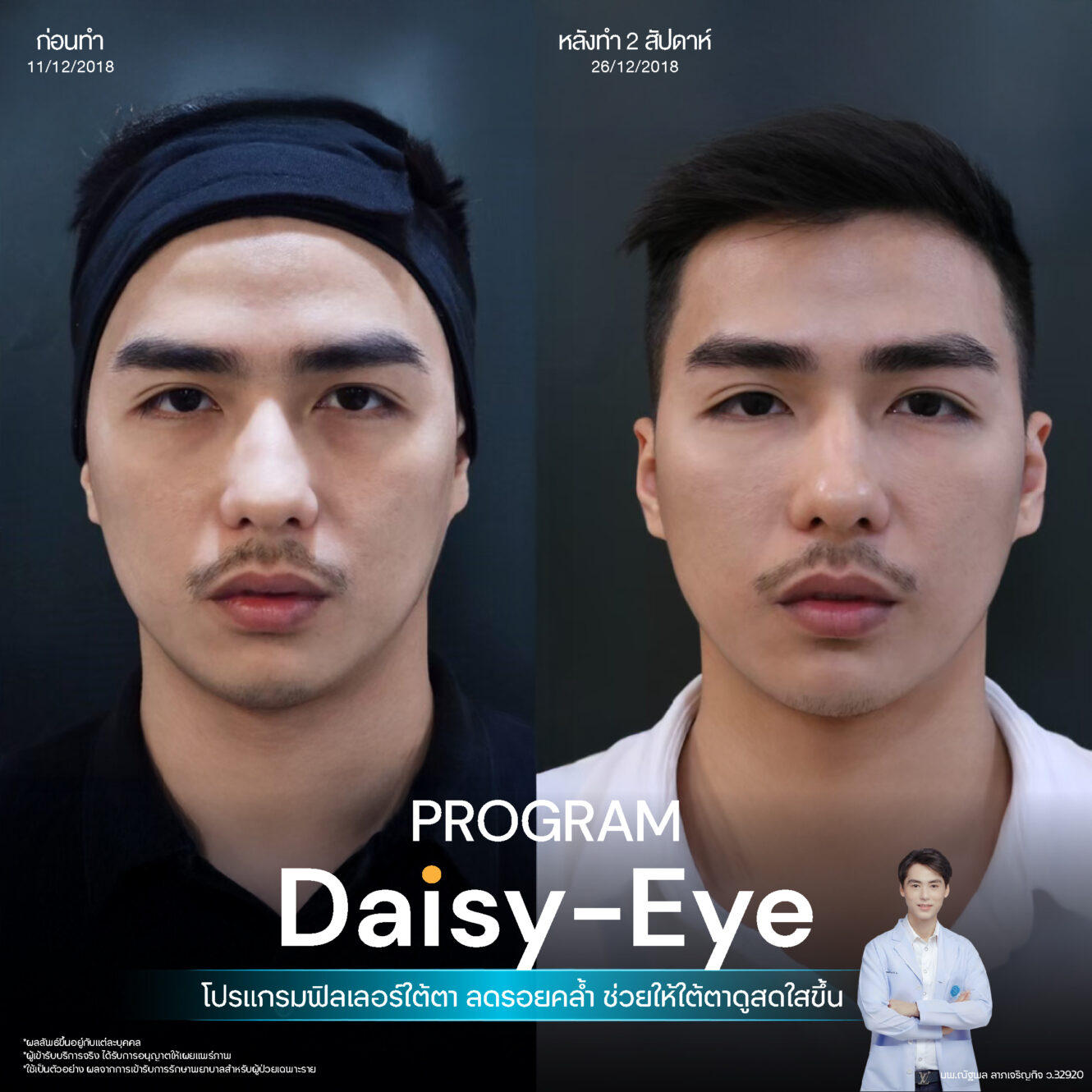 Anatomy บริเวณใต้ตา (Tear Trough Anatomy) 18 Filler ใต้ตา 28