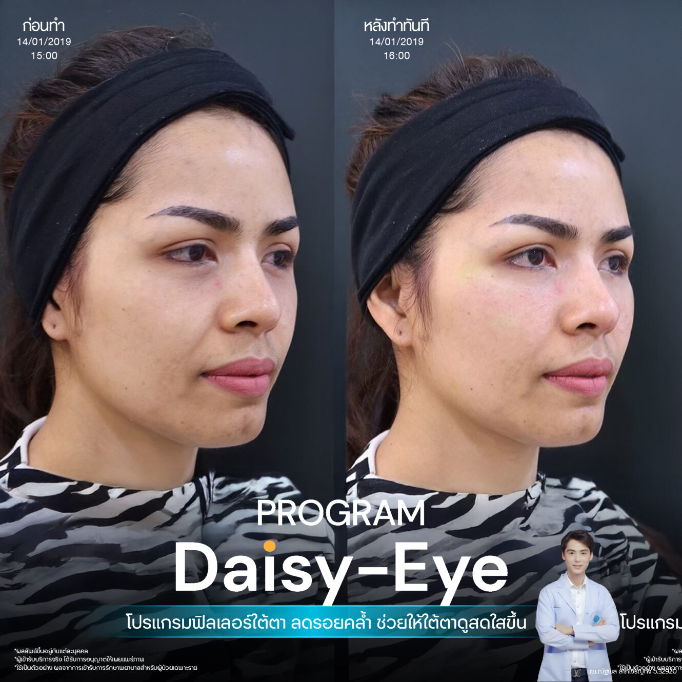 โปรแกรม Restylane Vital Light ลดริ้วรอยและร่องลึกใต้ตา 8 Filler ใต้ตา 31