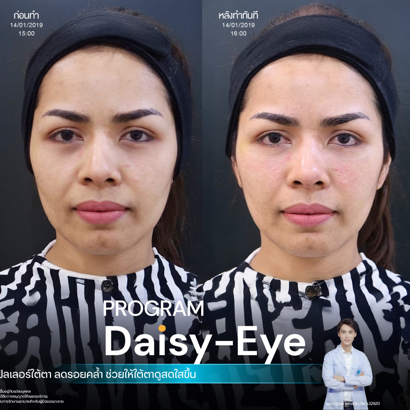 โปรแกรม Restylane Vital Light ลดริ้วรอยและร่องลึกใต้ตา 7 Filler ใต้ตา 32