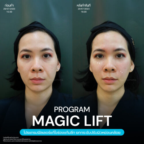โปรแกรมฟิลเลอร์ (Filler) คืออะไร? ดีจริงไหม มีอะไรที่ควรรู้ก่อนฉีดบ้าง 2 Magic Lift 19