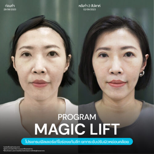 วิธีดูแลตัวเองหลังฉีดโปรแกรมฟิลเลอร์แก้ไขทรงแก้ม Magic Lift โดยแพทย์ Infiniz clinic 3 Magic Lift 23