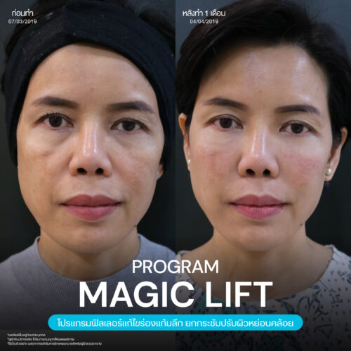 โปรแกรมฟิลเลอร์ Restylane ดีไหม ของแท้ดูอย่างไร ราคาเท่าไหร่บ้าง และข้อควรรู้ก่อนฉีด 8 Magic Lift 27