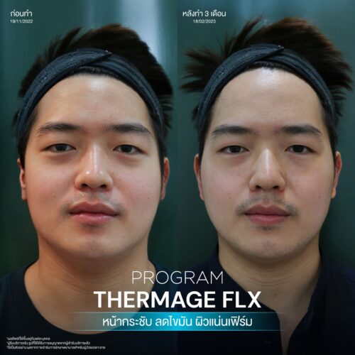 โปรแกรม Thermage FLX คืออะไรและมีหลักการทำงานอย่างไร เพื่อยกกระชับผิวหน้า 6 BA Thermage 07