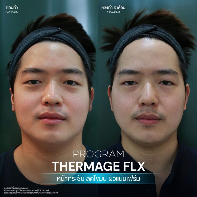 BA Thermage 07