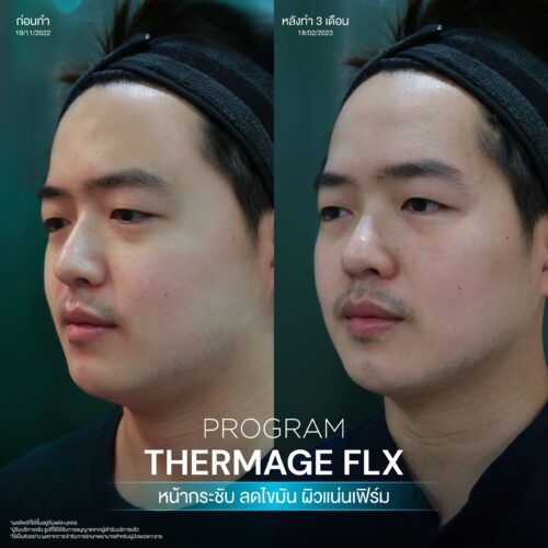 โปรแกรม Thermage FLX คืออะไรและมีหลักการทำงานอย่างไร เพื่อยกกระชับผิวหน้า 7 BA Thermage 08